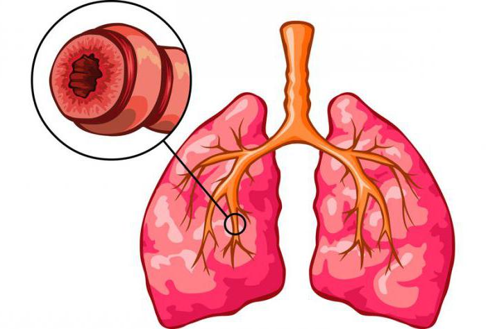 s'ils prennent dans l'armée avec l'asthme bronchique